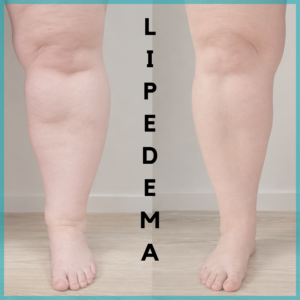 Lipedema lipodemia Białystok, ćwiczenia, obrzęki, ból