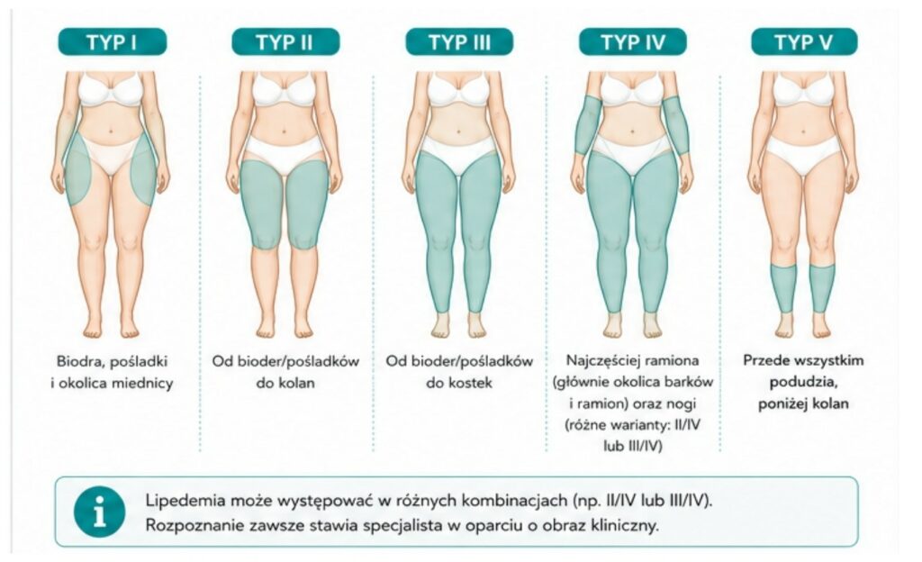 Typy i stadia lipodemii – klasyfikacja